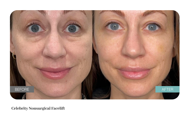 Before and after treatment result — Dr. Lanna, LC Medical Aesthetics NYC